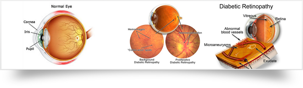 Laser retinian
